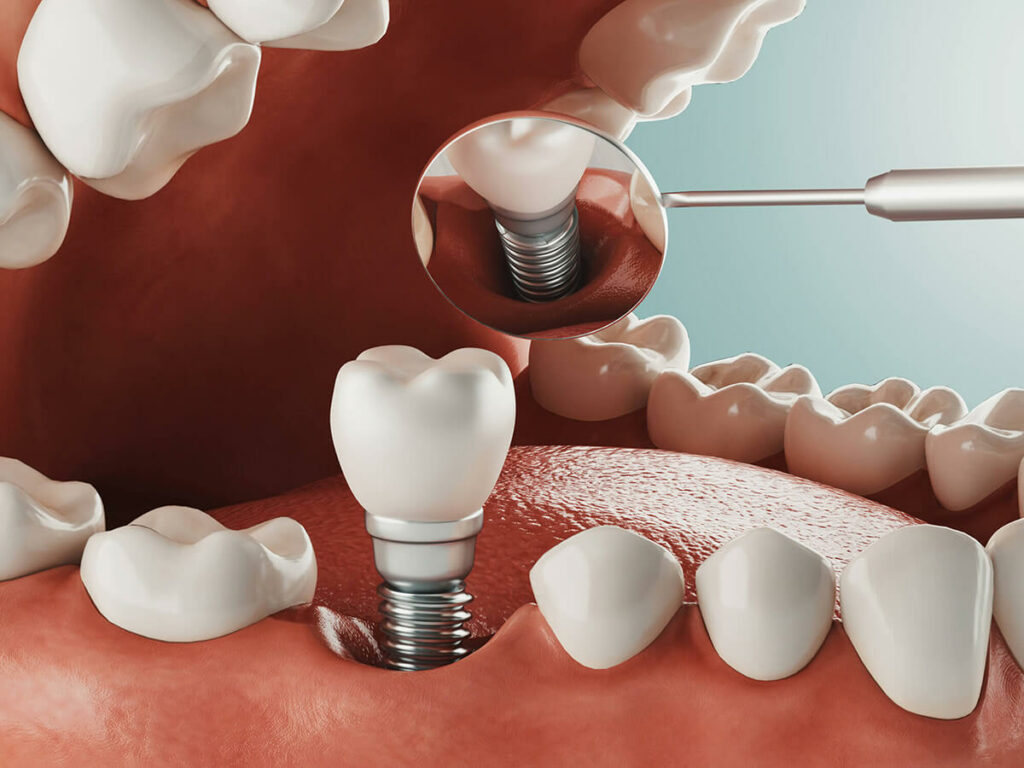 graphic of a dental implant being placed