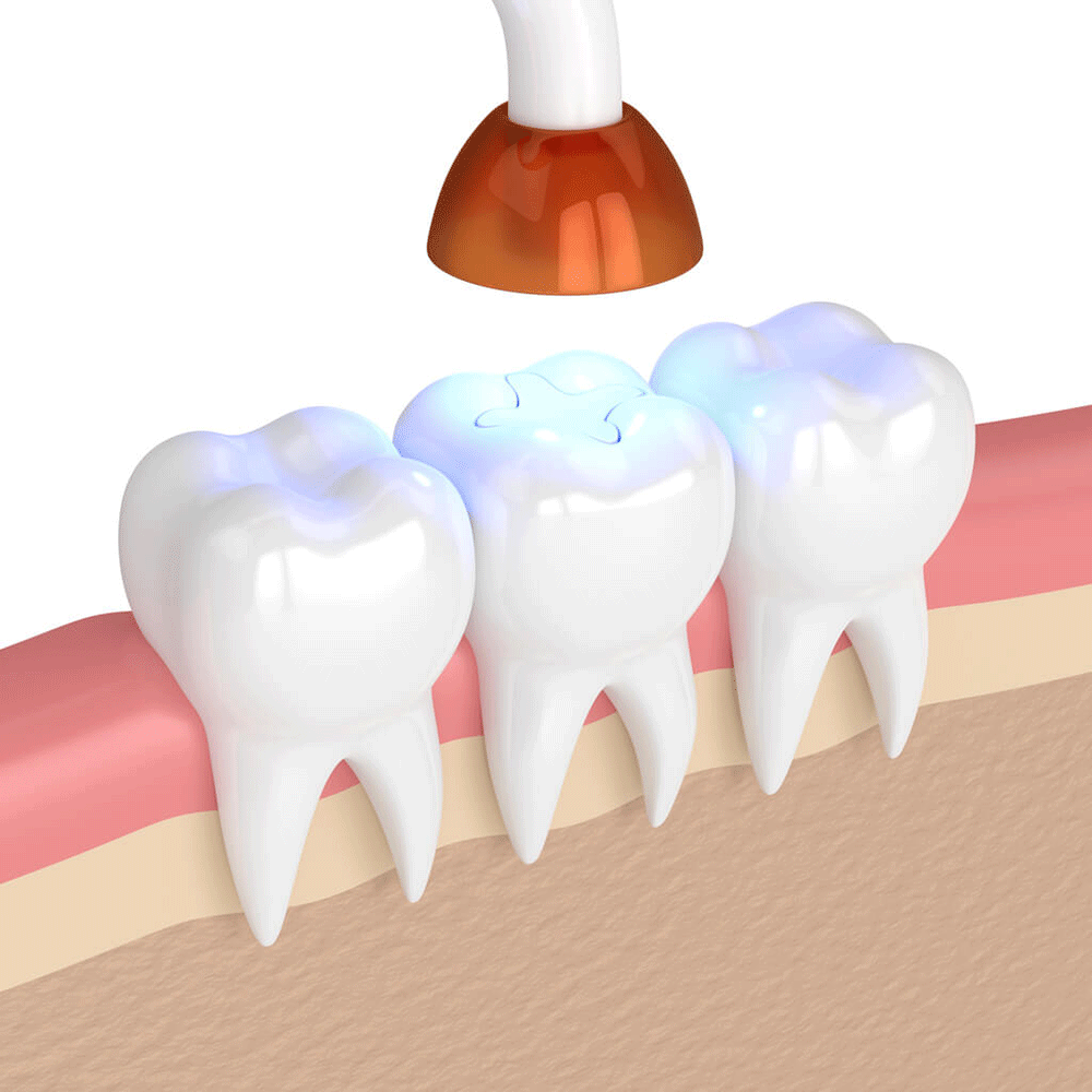The image shows a dental procedure involving three teeth. A dental curing light, which is an orange-colored device, is being used to harden or cure a dental material on the surface of the middle tooth.