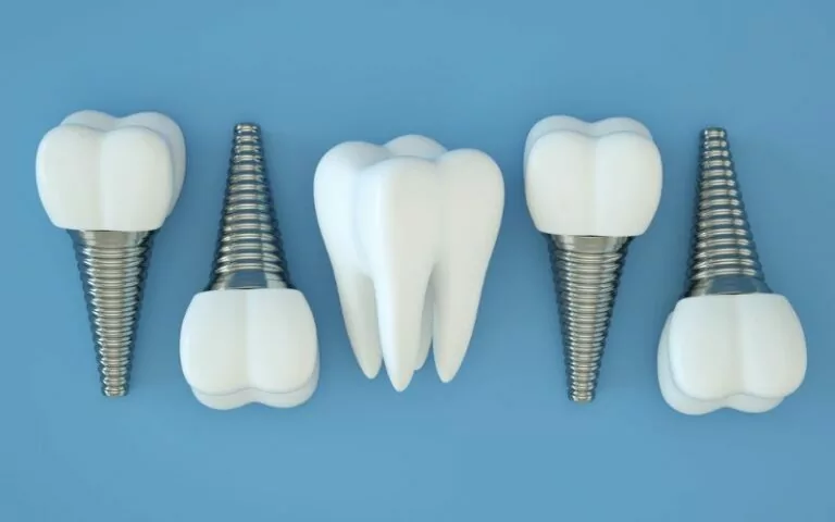 image of dental implants