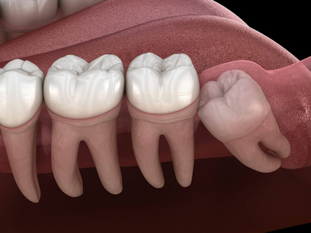 graphic of compacted wisdom teeth