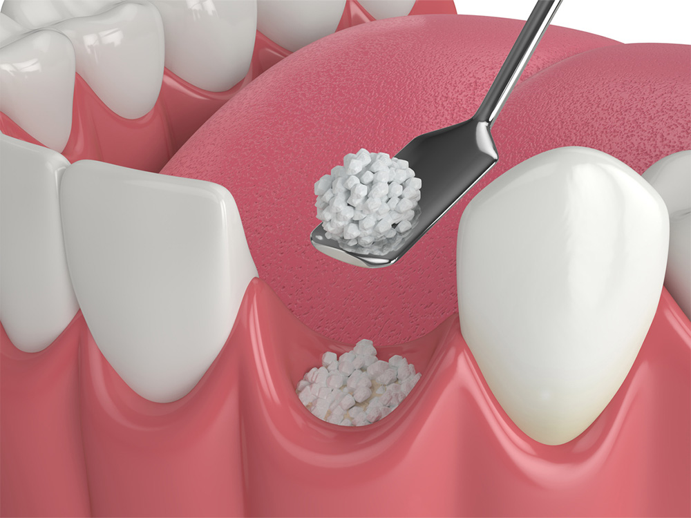 graphic of dental bone grafting