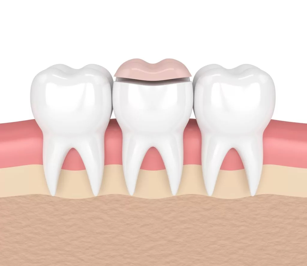 graphic of dental inlays and onlays