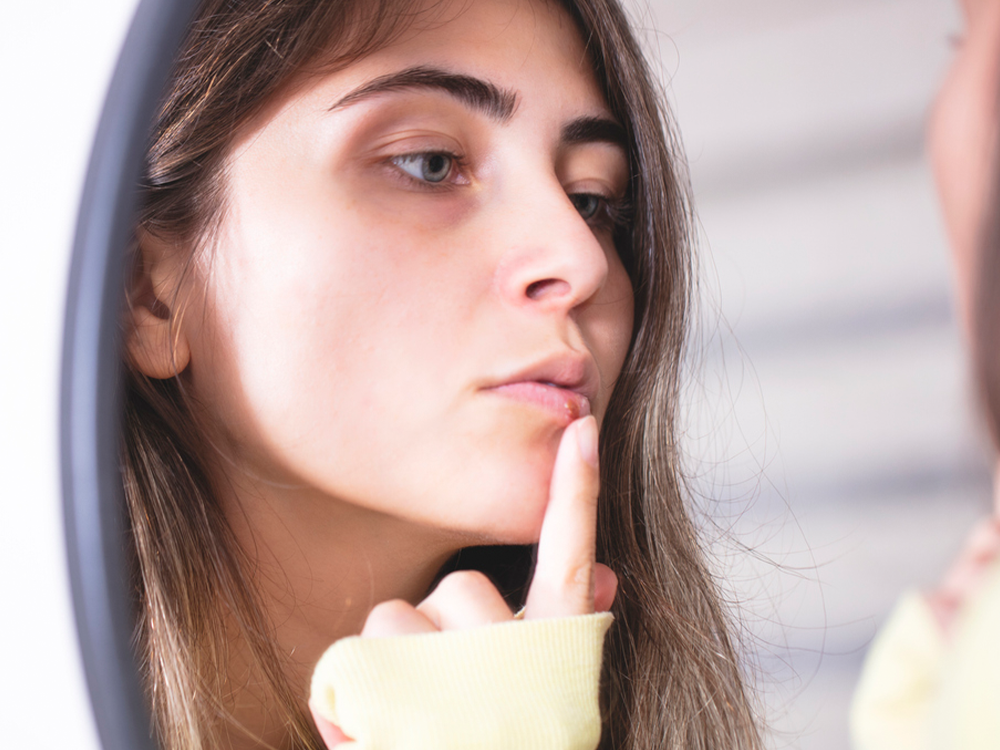 women looking at herself in the mirror with a cold sore on her lip