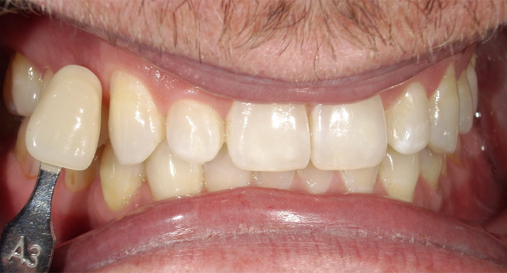 Close-up of teeth being compared to a dental shade guide, specifically the A3 shade, indicating natural tooth discoloration against the lighter shade standard.