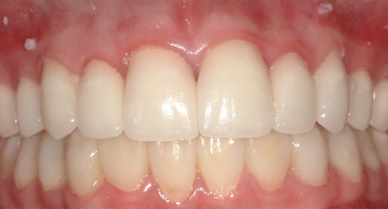 Close-up of clean, well-aligned human teeth with healthy gums, illustrating good dental hygiene.