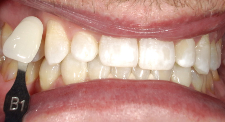Close-up of teeth being compared to a B1 shade guide, with natural teeth showing discoloration and yellowing, contrasted against the lighter, standardized shade.