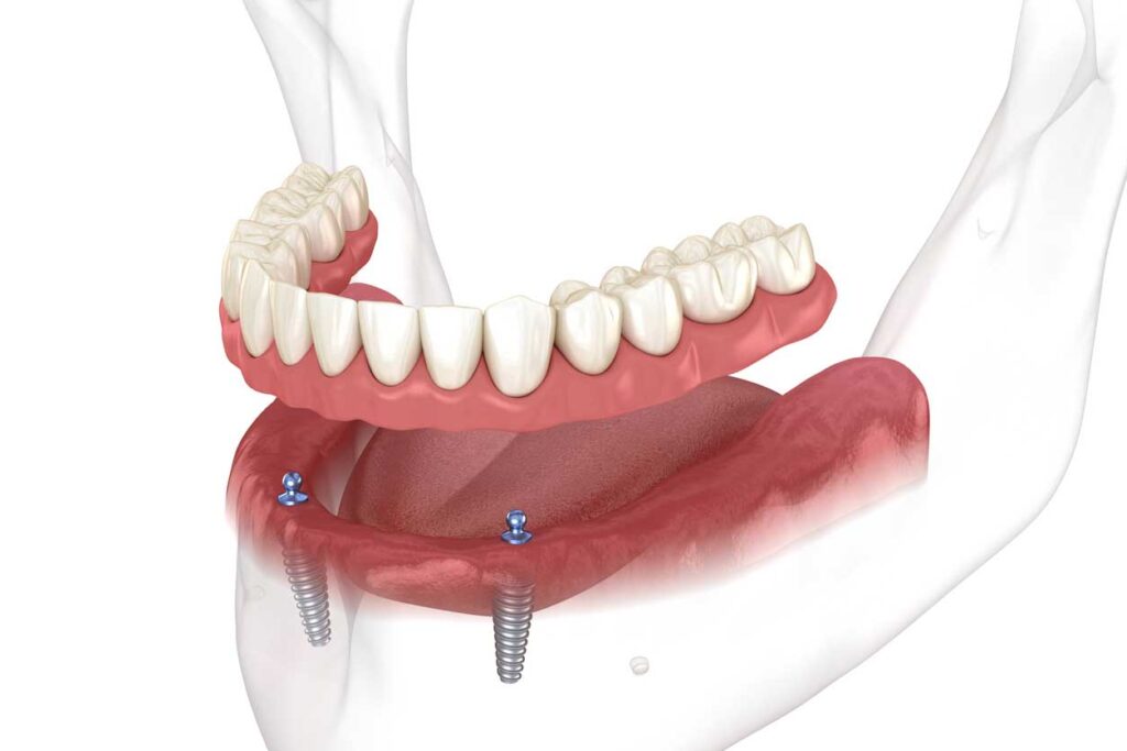 3D illustration of lower jaw showing two dental implants supporting an overdenture with artificial teeth.