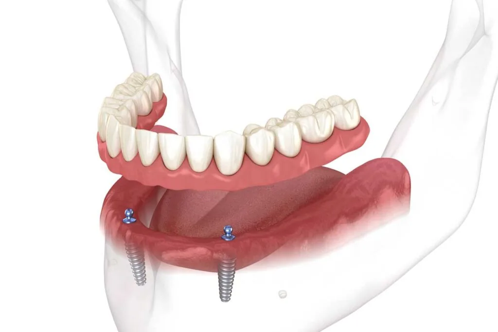3D illustration of lower jaw showing two dental implants supporting an overdenture with artificial teeth.