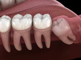 Impacted wisdom tooth